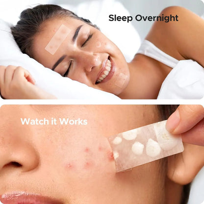 Box containing 302 transparent plastic acne cover patches for spot treatment.