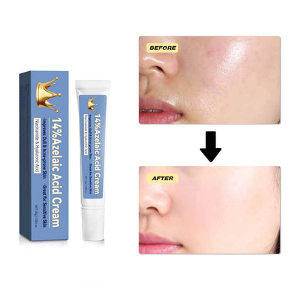 Blue azelaic acid cream tube with 30g content and FPA035 product code