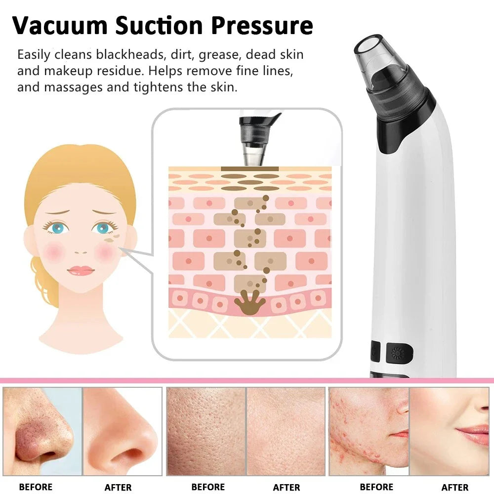Advanced electric blackhead remover vacuum with customisable suction and interchangeable heads for deep pore cleansing and skin rejuvenation