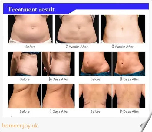 Ultrasonic Cavitation Fat Burner Device with Infrared Therapy and Microcurrent for Body Slimming and Anti-Cellulite Treatment