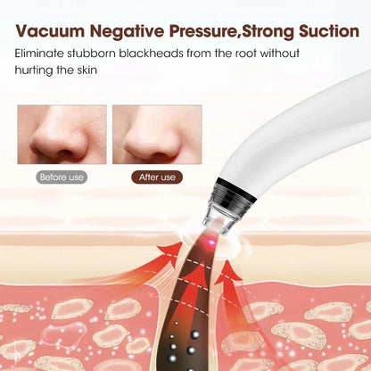 Advanced electric blackhead remover vacuum with customisable suction and interchangeable heads for deep pore cleansing and skin rejuvenation