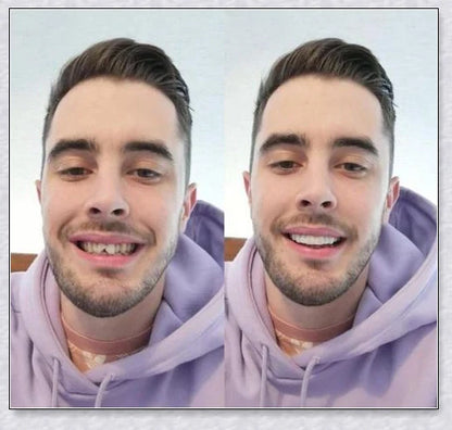 Premium teeth veneers that instantly transform your smile by concealing crooked, stained, or missing teeth